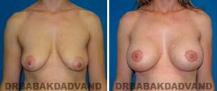 Breast Lift. Before and After Photos. 33 year old woman - front view