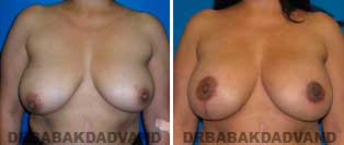 Breast Lift. Before and After Photos. 43 year old woman - front view