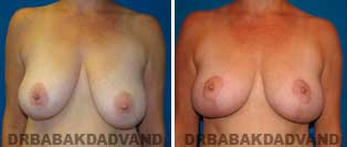 Breast Lift. Before and After Photos. 42 year old woman - front view