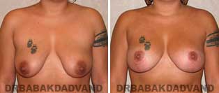 Breast Lift. Before and After Photos. 26 year old woman - front view