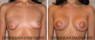 Breast Lift. Before and After Photos. 20 year old woman - front view