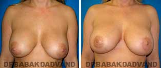 Breast Lift. Before and After Photos. 42 year old female - front view