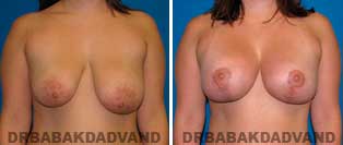 Breast Lift. Before and After Photos. 28 year old woman - front view