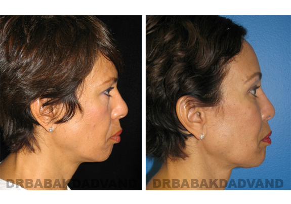 Before - After Photos |Chin Augmentation| female, right side view
