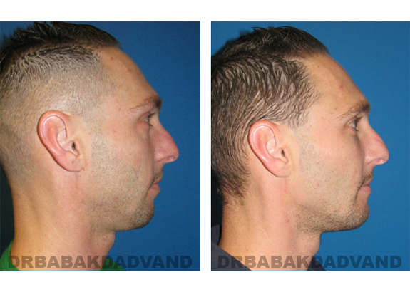 Before - After Photos |Chin Augmentation| male, right side view