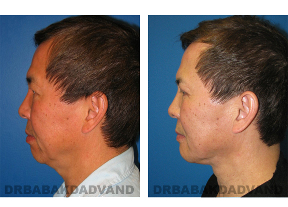 Before - After Photos |Chin Augmentation| man, left side view