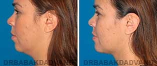 Face Before & After Photos. Chin Augmentation