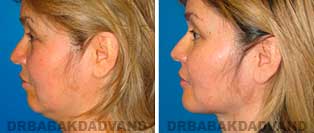 Chin Augmentation: Before and After Photos - female, left side view