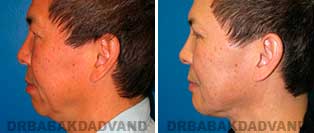 Chin Augmentation: Before and After Photos - man, left side view