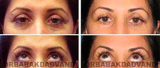 Face Before & After Photos. Eyelid (Blepharoplasty)