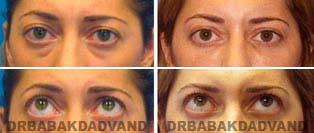 Eyelid: Before and After Photos - 34 year old female, front view