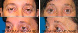 Eyelid: Before and After Photos - 56 year old female, front view (oblique view)