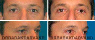 Eyelid: Before and After Photos - 36 year old male, front view (oblique view)