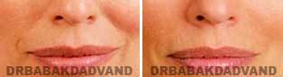 Non Surgical Before & After Photos: JUVEDERM