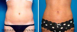 Body Before & After Photos: Liposuction