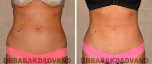Liposuction: Before and After Photos - 30 year old female - front view