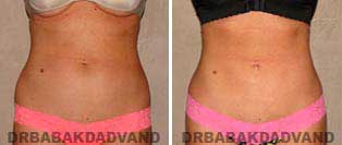 Liposuction of the flanks Beverly Hills - Smaller Waist- Flanks Lipo