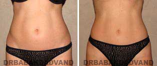 Liposuction: Before and After Photos - 40 year old female - front view