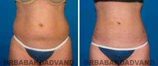 Liposuction: Before and After Photos - 27 year old female - front view