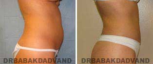 Liposuction: Before and After Photos - 40 year old female - right side view