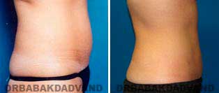 Liposuction: Before and After Photos - 32 year old female - right side view