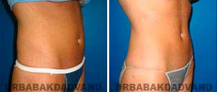Liposuction: Before and After Photos - 32 year old female - right side oblique view