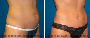 Liposuction: Before and After Photos - 33 year old female - right side oblique view