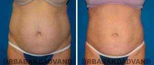 Liposuction: Before and After Photos - 43 year old female - front view