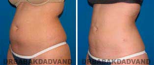 Liposuction: Before and After Photos - 28 year old female - left side oblique view