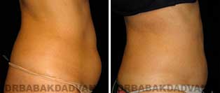 Liposuction: Before and After Photos - 55 year old female - right side view