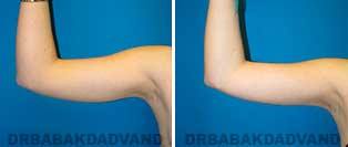 Liposuction: Before and After Photos - 22 year old female - front view(liposuction of her arms)