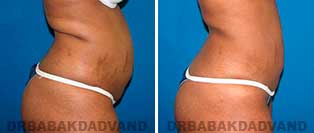 Liposuction: Before & After Photos - 32 year old female - right side view