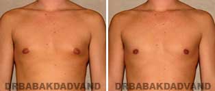 Gynecomastia. Before and After Photos. 31 year old male - front view
