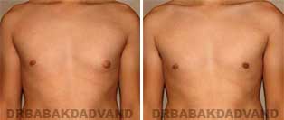 Gynecomastia. Before & After Photos. 24 year old male - front view
