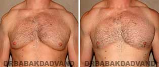 Gynecomastia. Before and After Photos. 39 year old man - front view