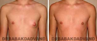 Gynecomastia. Before and After Photos. 16 year old man - front view