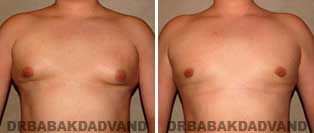 Gynecomastia. Before and After Photos. 21 year old man - front view