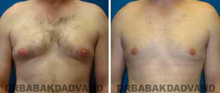 Gynecomastia. Before and After Photos. 28 year old man - front view