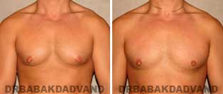 Gynecomastia. Before and After Photos. 22 year old male - front view