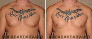 Gynecomastia. Before and After Photos. 24 year old male - front view