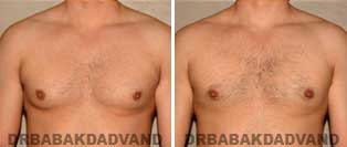 Gynecomastia. Before and After Photos. 32 year old male - front view