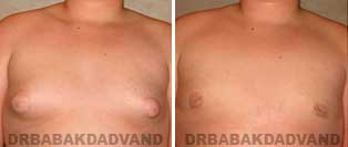 Gynecomastia. Before and After Photos. 16 year old male - front view