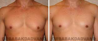 Gynecomastia. Before and After Photos. 26 year old male - front view