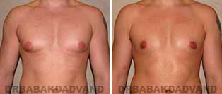 Gynecomastia. Before & After Photos. 24 year old man - front view