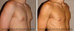 Gynecomastia. Before and After Photos. 17 year old male - right side oblique view
