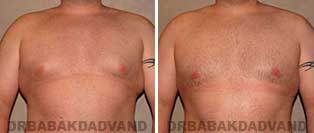 Gynecomastia. Before & After Photos. 28 year old man - front view