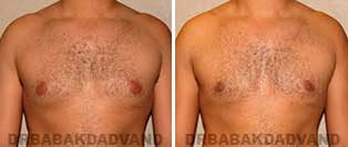 Before & After Photos. Gynecomastia. 28 year old. Man - front view