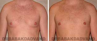 Before and After Photos. Gynecomastia. 28 year old. Man - front view