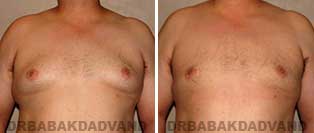 Before & After Photos. Gynecomastia. 35 year old. Man - front view