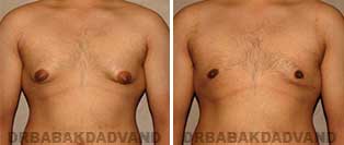 Before & After Photos. Gynecomastia. 23 year old. Man - front view